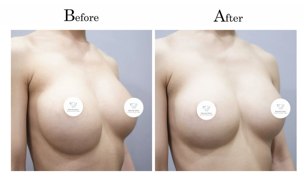 高雄隆乳失敗隆乳後胸部ㄧ高ㄧ低(高低胸)002