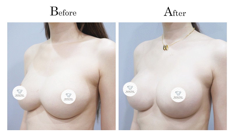 高雄隆乳失敗隆乳後造成兩乳房連在一起(連通奶)002