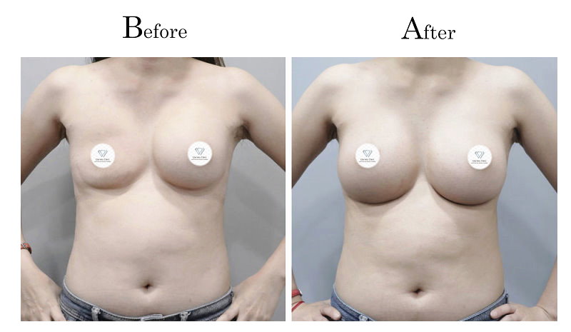 高雄隆乳失敗假體破裂01