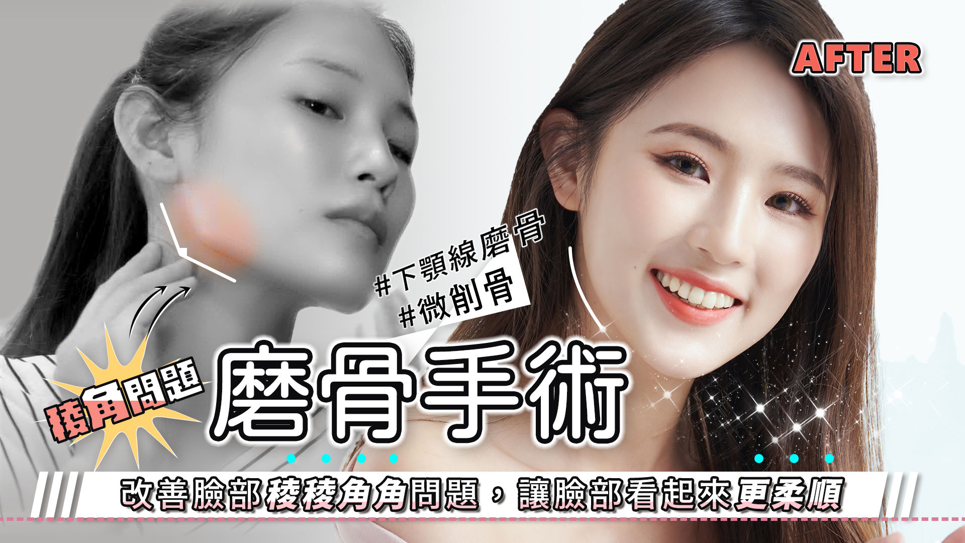 台南磨骨手術權威醫師推薦邱智弘