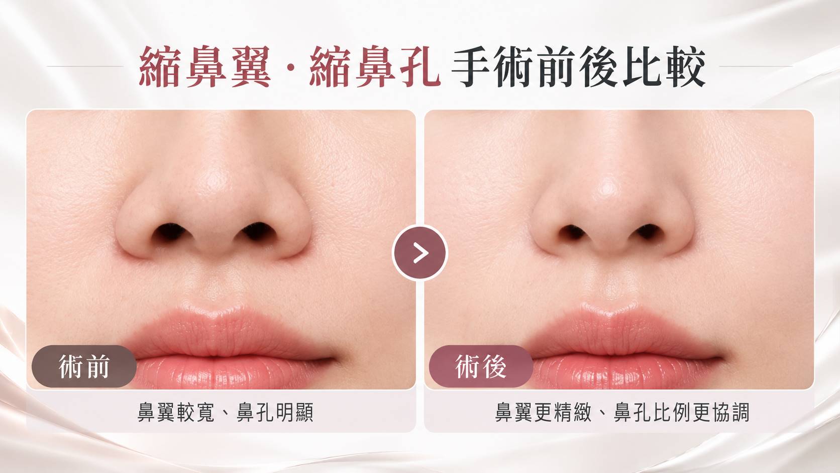 台南縮鼻翼縮鼻孔手術權威醫師推薦價格費用多少004
