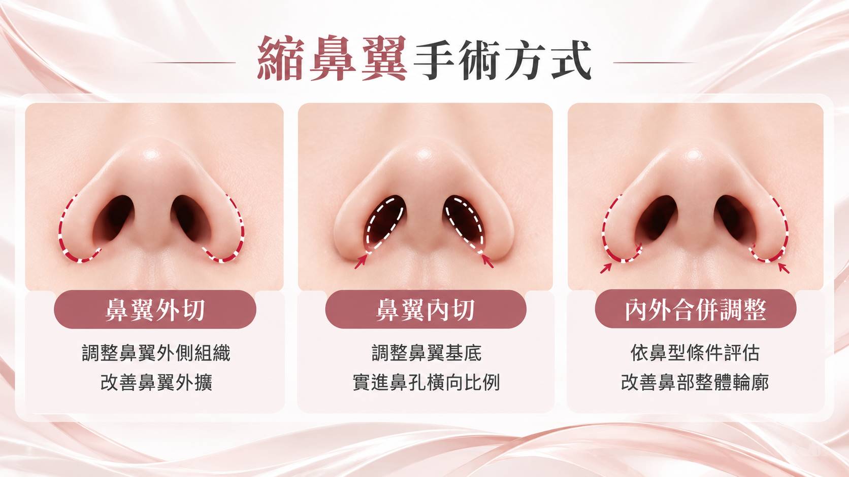 台南縮鼻翼縮鼻孔手術權威醫師推薦價格費用多少007