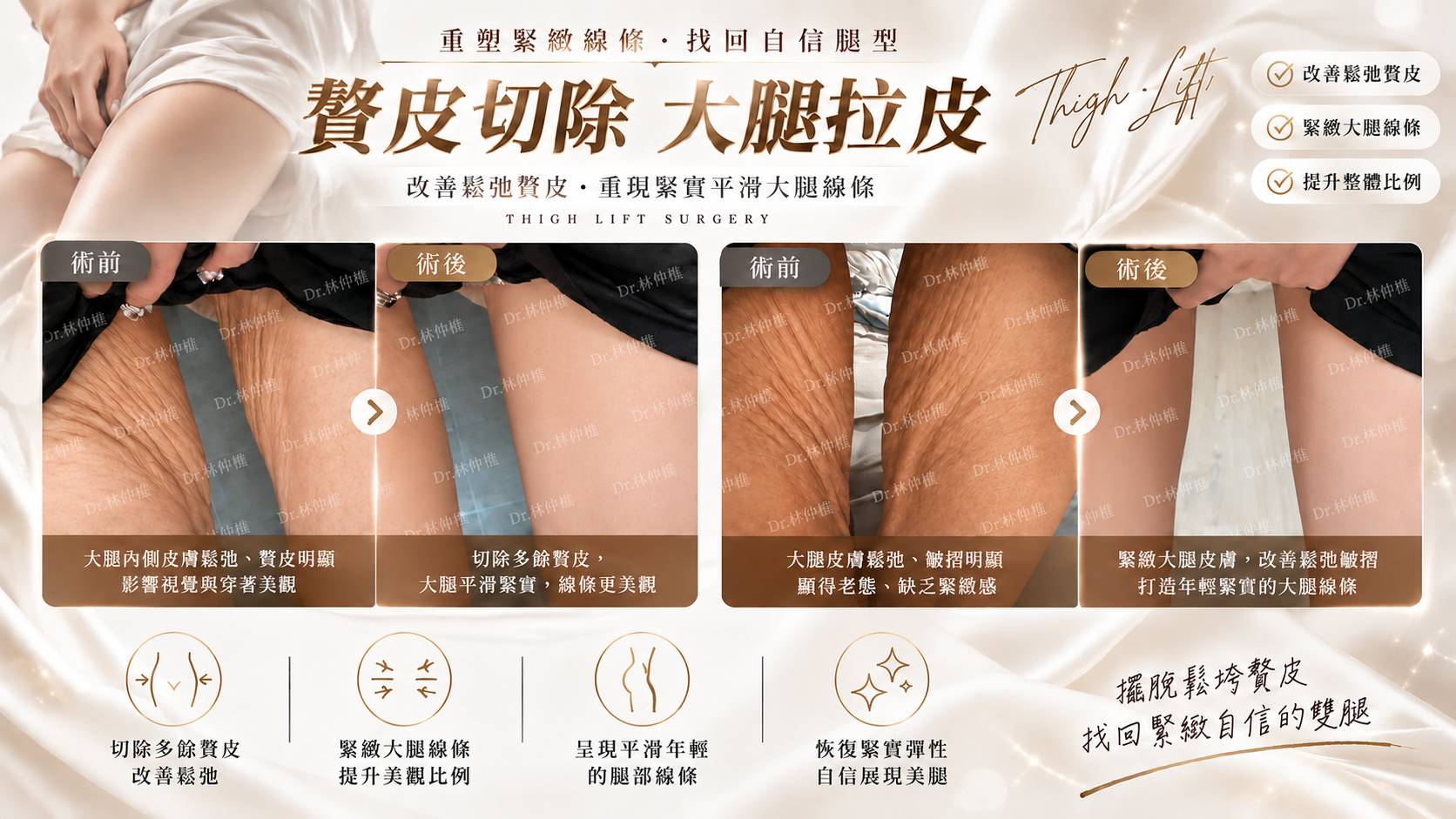 台南贅皮切除修皮手術大腿拉皮手臂拉皮腹部拉皮權威醫師推薦價格費用介紹99